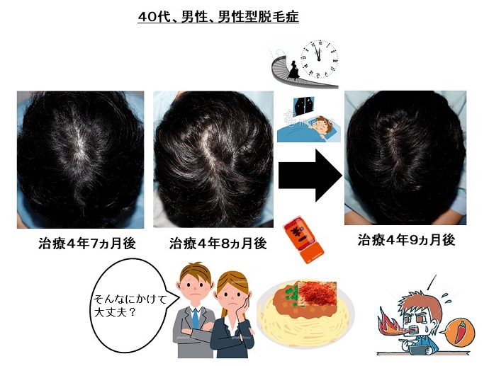 円形脱毛症　病院
